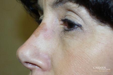 Laser Skin Resurfacing - Face: Patient 1 - Before Image 1