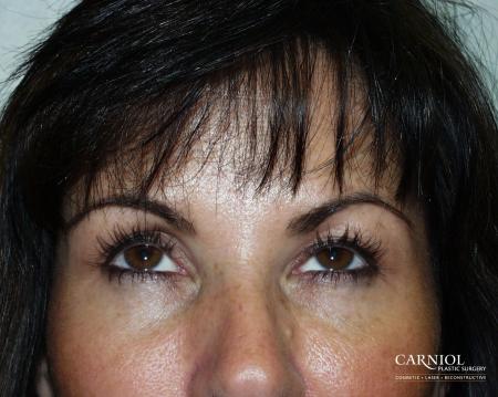 BOTOX® Cosmetic: Patient 2 - After Image