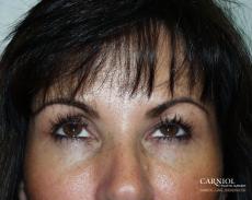 BOTOX® Cosmetic: Patient 2 - After Image