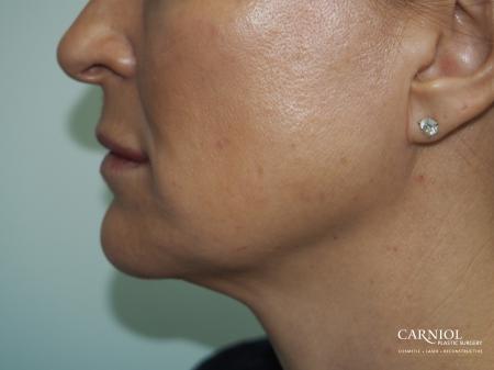 Cheek Boost - After Image 1