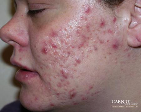 Acne Rejuvenation: Patient 1 - Before Image 1