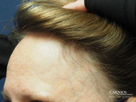 Nonsurgical Hair Restoration: Patient 1 - After Image 3
