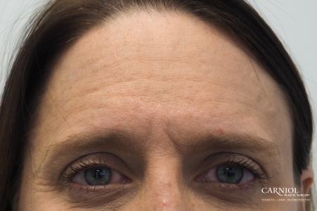 BOTOX® Cosmetic: Patient 4 - Before Image