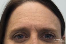 BOTOX® Cosmetic: Patient 4 - Before Image