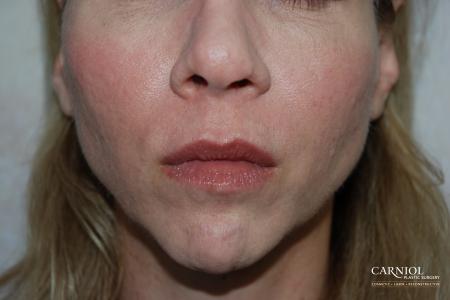 Non-Surgical Mini-Facelift: Patient 8 - After Image 1