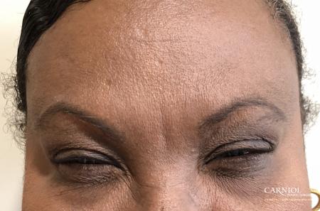 BOTOX® Cosmetic: Patient 3 - After Image
