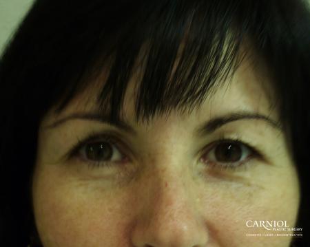 BOTOX® Cosmetic: Patient 2 - Before Image