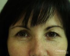 BOTOX® Cosmetic: Patient 2 - Before Image