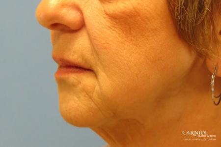 Non-Surgical Mini-Facelift: Patient 9 - After Image 3