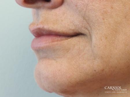 Lip Augmentation: Patient 8 - After Image 3