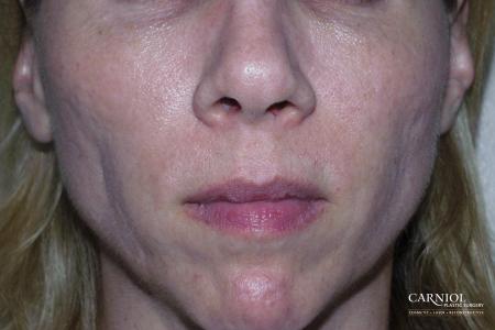 Non-Surgical Facelift: Patient 10 - Before Image 1