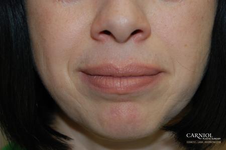 Fillers: Patient 2 - After Image 1
