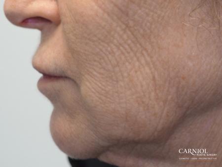 Laser: Patient 1 - After Image 1