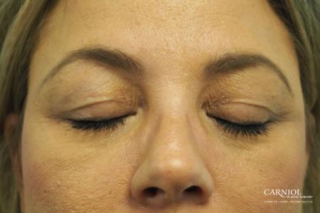 Blepharoplasty: Patient 2 - Before and After Image 2