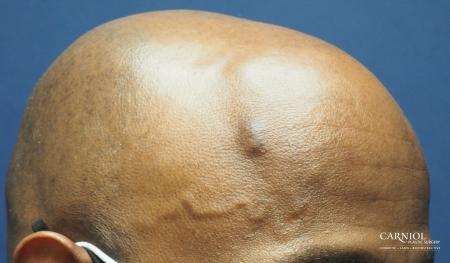 Mole/Age Spot Removal: Patient 3 - Before Image 1