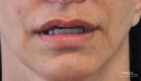 Lip Augmentation: Patient 8 - After Image 1