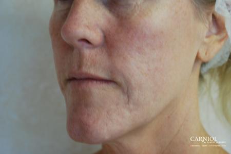 Fractional Resurfacing: Patient 3 - Before Image 1