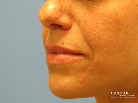 Scar Revision: Patient 3 - Before Image 2
