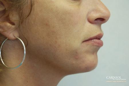 Non-Surgical Mini-Facelift: Patient 3 - After Image 1