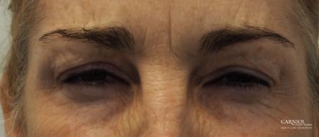 BOTOX® Cosmetic: Patient 5 - After Image 3