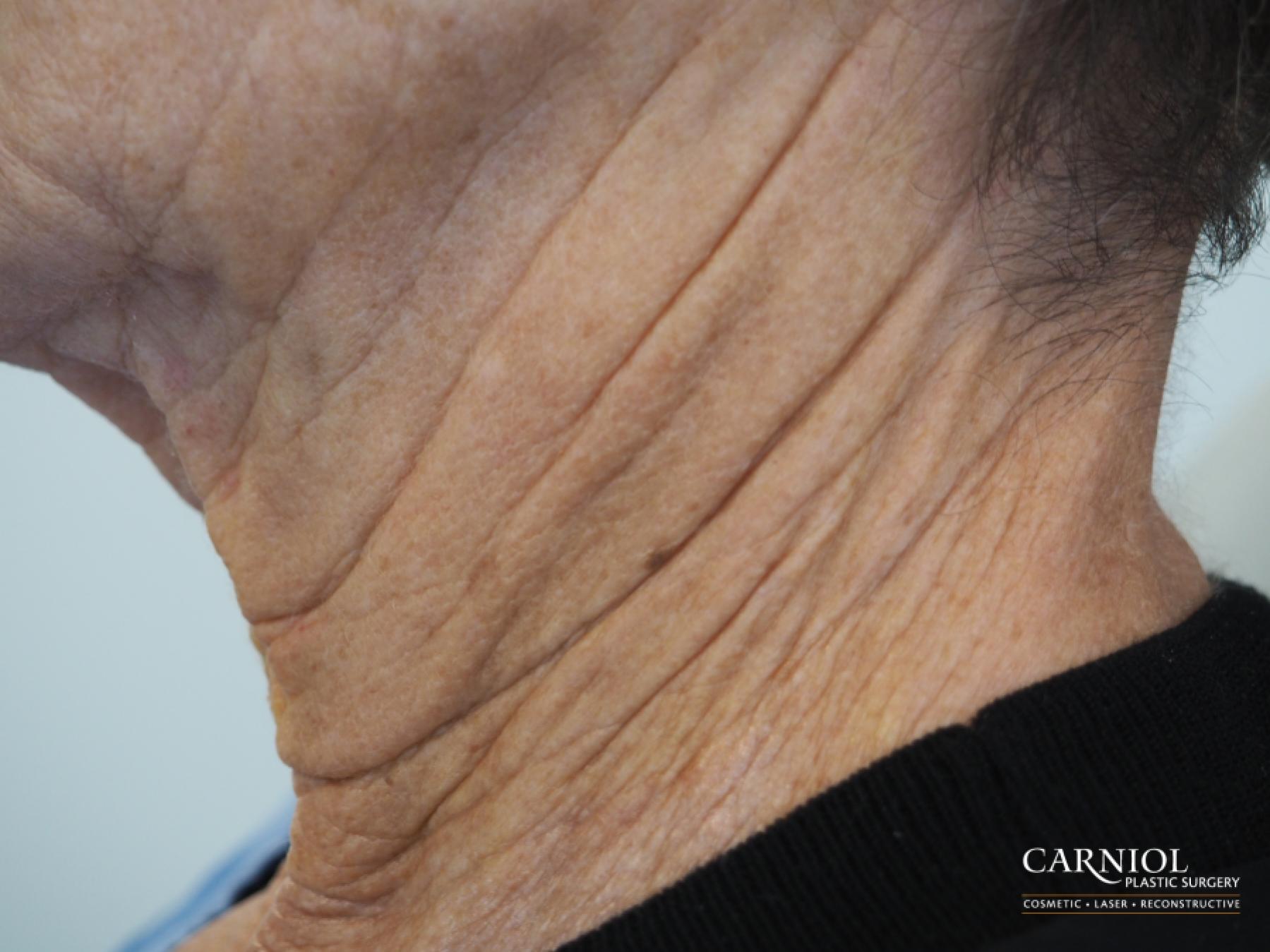 Non-Surgical Neck Lift: Patient 2 - Before 