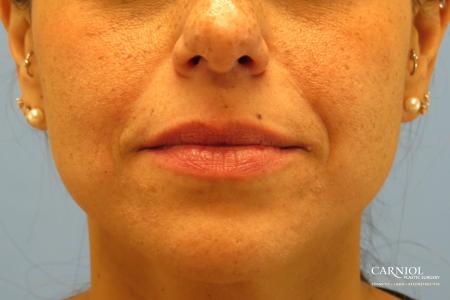 Lip Augmentation: Patient 1 - Before Image 1