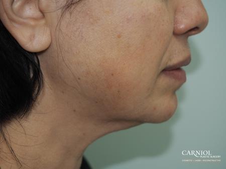 Non-Surgical Mini-Facelift: Patient 1 - After Image 1