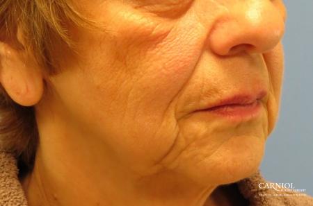 Non-Surgical Facelift: Patient 1 - Before Image 2