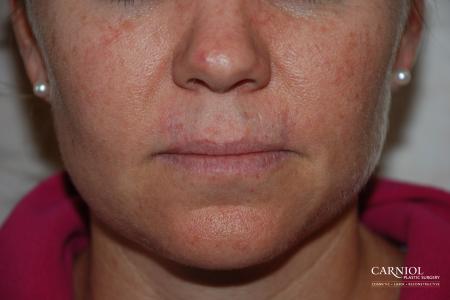 Skin Cancer Reconstruction - Face: Patient 6 - After Image 1