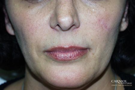 Scar Revision: Patient 1 - After Image 1