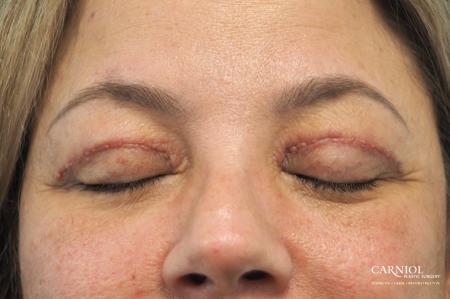 Blepharoplasty: Patient 1 - After Image 2