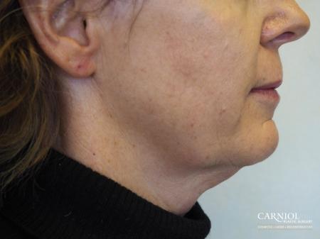 Facial Tightening: Patient 5 - After Image 1