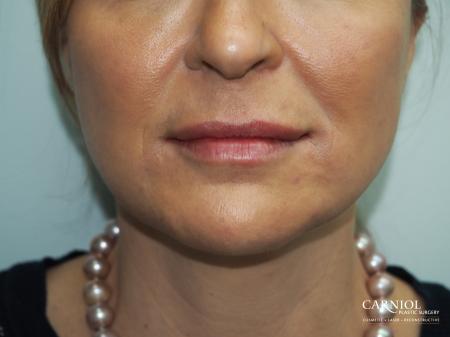 Fillers: Patient 5 - After Image 1