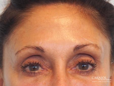 BOTOX® Cosmetic: Patient 6 - After Image