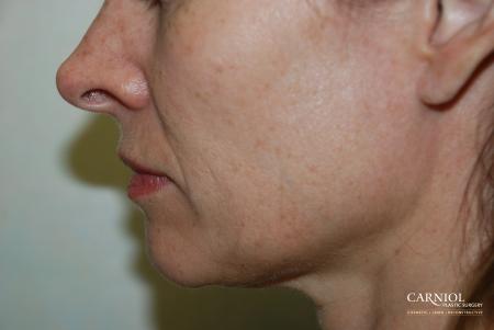 Fractional Resurfacing: Patient 1 - Before Image 1