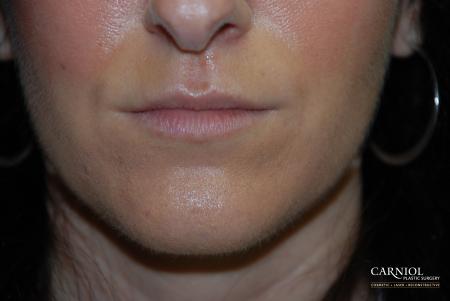 Lip Augmentation: Patient 2 - Before Image 1