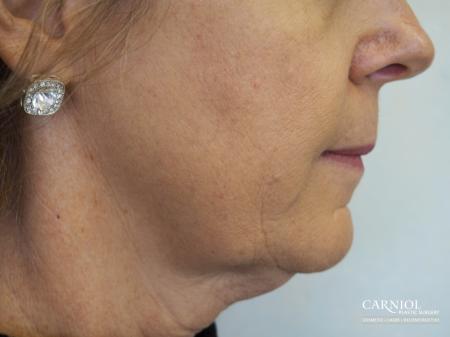 Facial Tightening: Patient 5 - Before Image 1