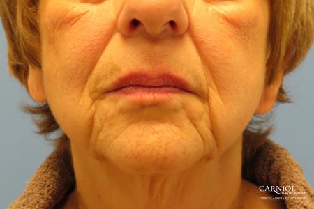 Non-Surgical Facelift: Patient 1 - Before Image 1