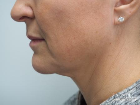 Cheek Boost - Before Image 1
