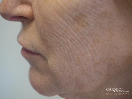 Laser: Patient 1 - Before Image 1
