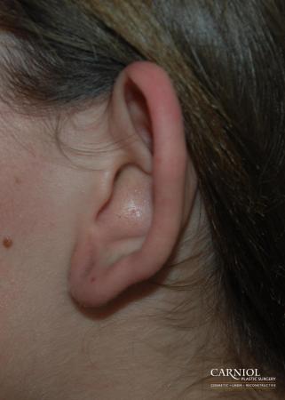 Ear Pinning - Before Image 1