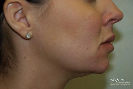 Facial Tightening: Patient 4 - After Image 1