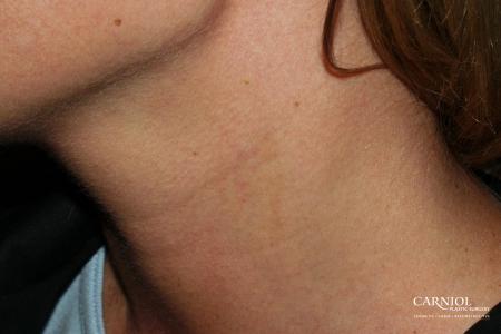 Port Wine Stain: Patient 1 - After Image 1
