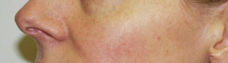 Rosacea: Patient 1 - After Image 1
