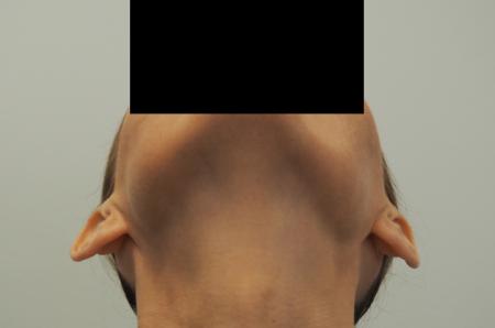 Otoplasty: Patient 3 - Before Image 2