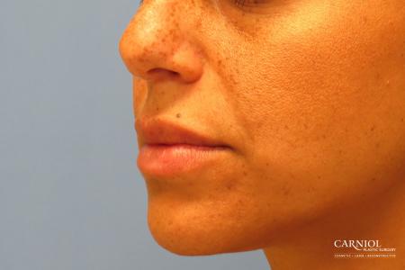 Lip Augmentation: Patient 1 - After Image 3