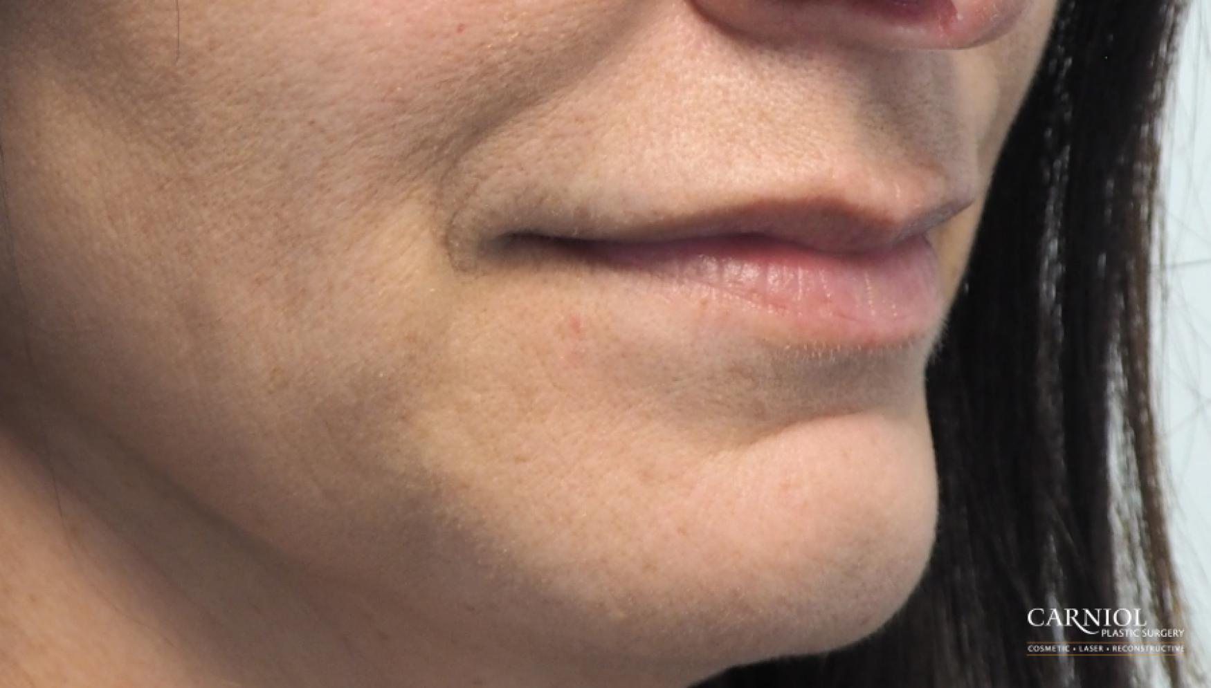 Lip Augmentation: Patient 8 - Before 2