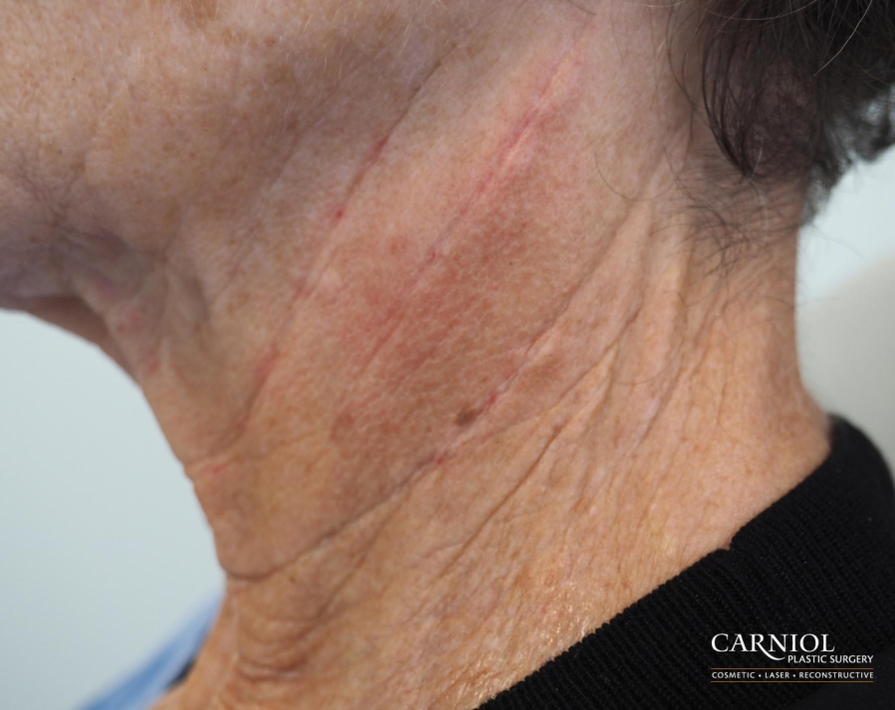 Non-Surgical Neck Lift: Patient 2 - After  