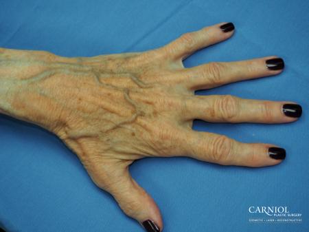 Radiesse Hand Rejuvenation - Before Image 1