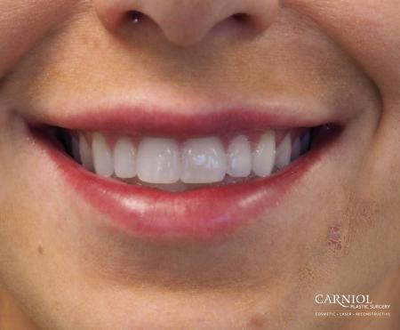 Lip Augmentation: Patient 7 - After Image 1